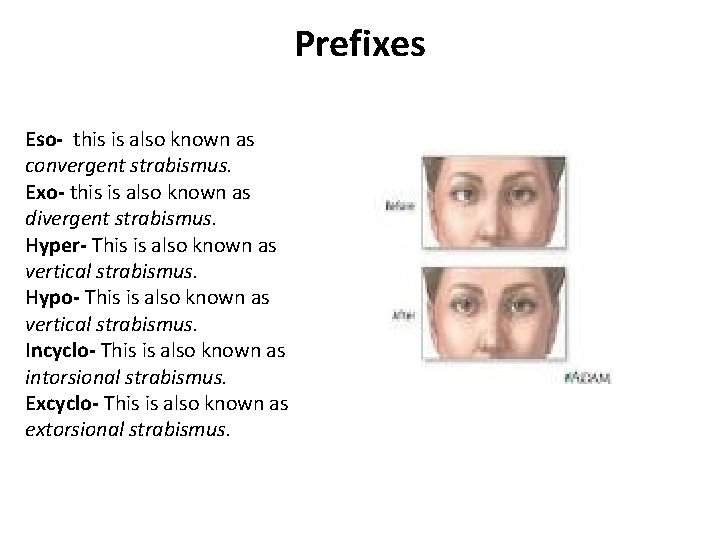 Prefixes Eso- this is also known as convergent strabismus. Exo- this is also known Prefixes Eso- this is also known as convergent strabismus. Exo- this is also known
