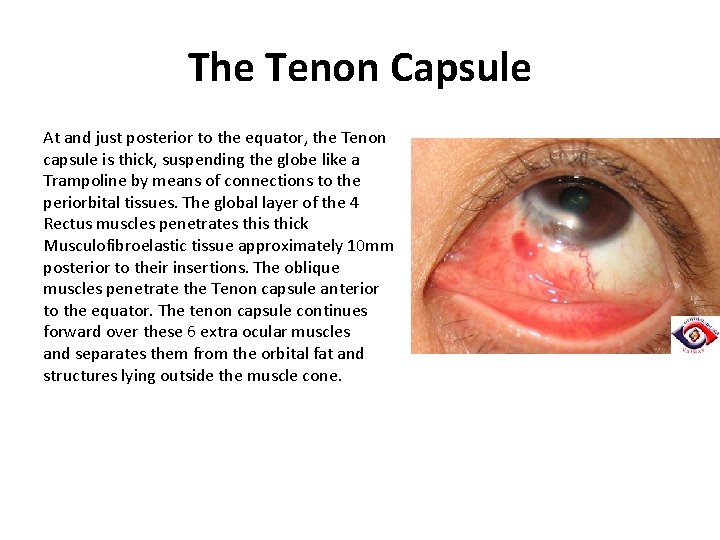 The Tenon Capsule At and just posterior to the equator, the Tenon capsule is The Tenon Capsule At and just posterior to the equator, the Tenon capsule is