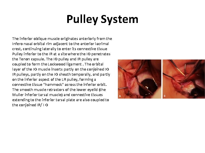 Pulley System The inferior oblique muscle originates anteriorly from the Infero nasal orbital rim Pulley System The inferior oblique muscle originates anteriorly from the Infero nasal orbital rim