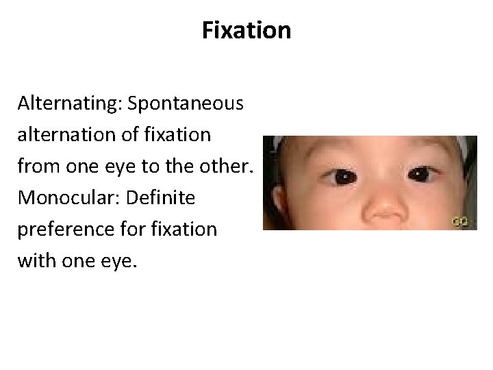 Fixation Alternating: Spontaneous alternation of fixation from one eye to the other. Monocular: Definite Fixation Alternating: Spontaneous alternation of fixation from one eye to the other. Monocular: Definite