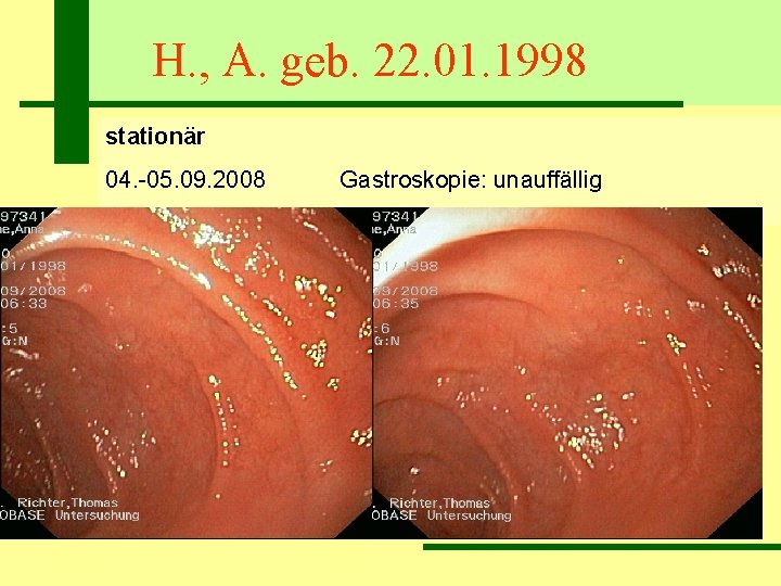 H. , A. geb. 22. 01. 1998 stationär 04. -05. 09. 2008 Gastroskopie: unauffällig