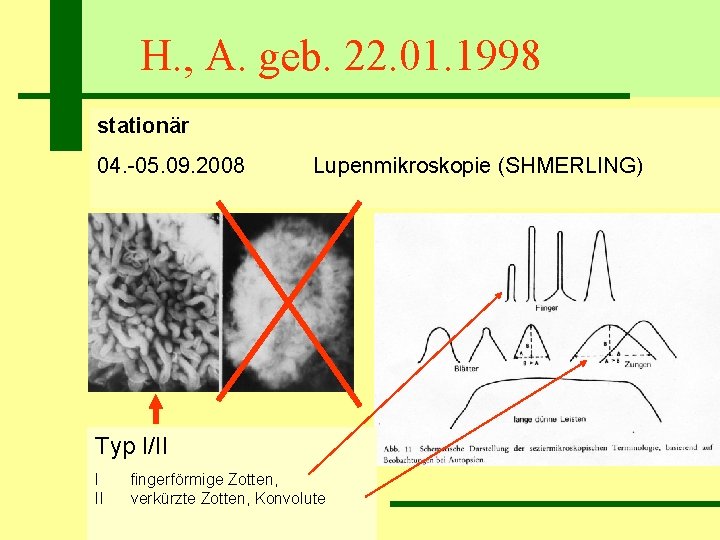 H. , A. geb. 22. 01. 1998 stationär 04. -05. 09. 2008 Lupenmikroskopie (SHMERLING)