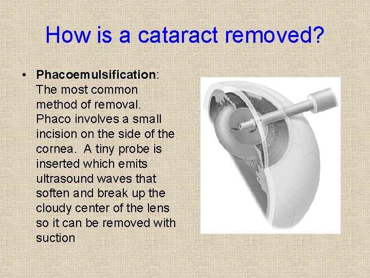 How is a cataract removed? • Phacoemulsification: The most common method of removal. Phaco