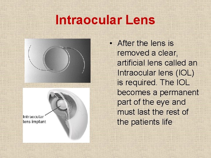 Intraocular Lens • After the lens is removed a clear, artificial lens called an