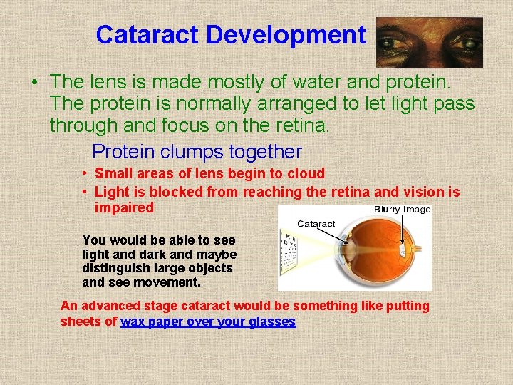 Cataract Development • The lens is made mostly of water and protein. The protein