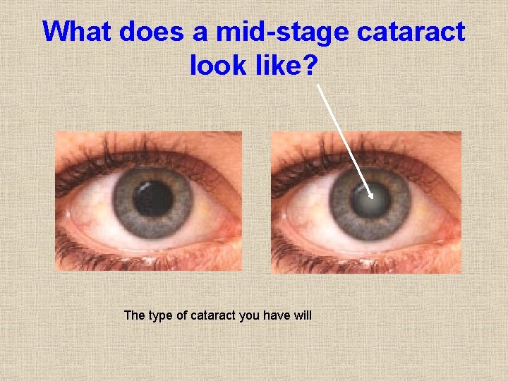 What does a mid-stage cataract look like? The type of cataract you have will