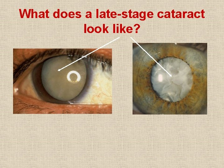 What does a late-stage cataract look like? 