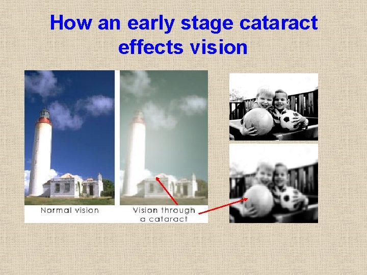 How an early stage cataract effects vision 