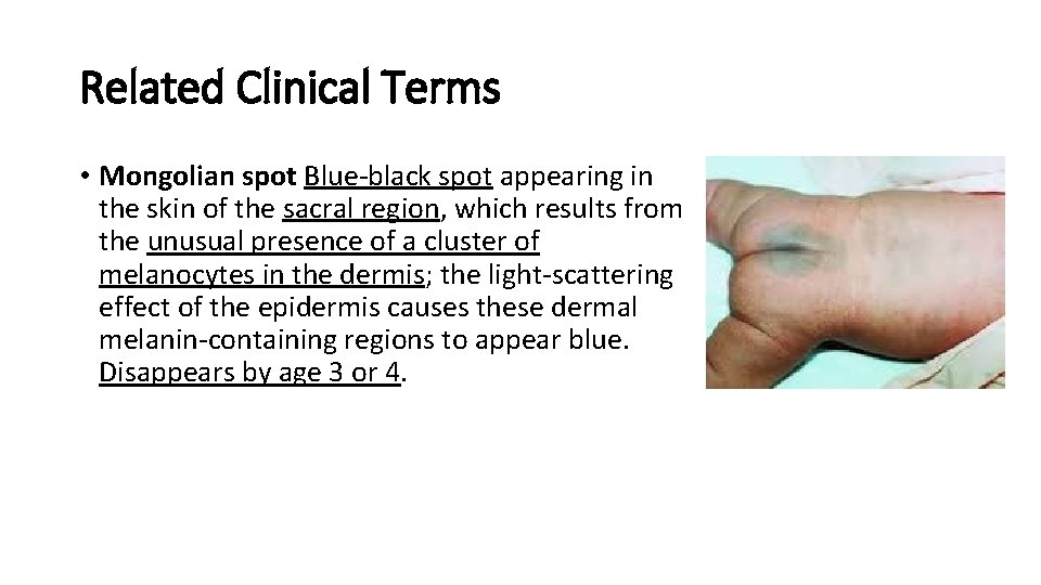 Related Clinical Terms • Mongolian spot Blue-black spot appearing in the skin of the