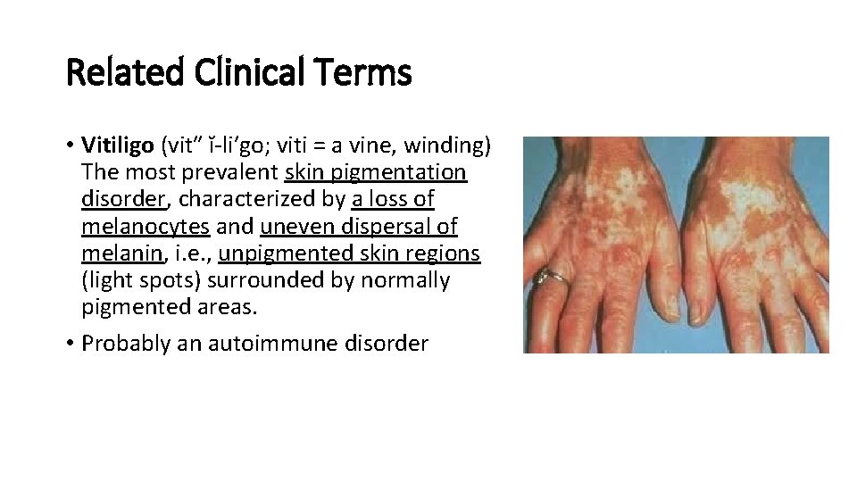 Related Clinical Terms • Vitiligo (vit″ ĭ-li′go; viti = a vine, winding) The most