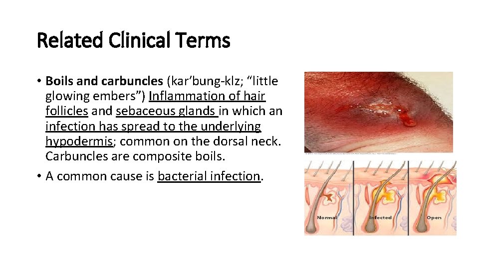Related Clinical Terms • Boils and carbuncles (kar′bung-klz; “little glowing embers”) Inflammation of hair