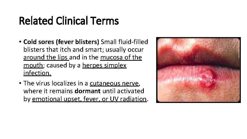 Related Clinical Terms • Cold sores (fever blisters) Small fluid-filled blisters that itch and