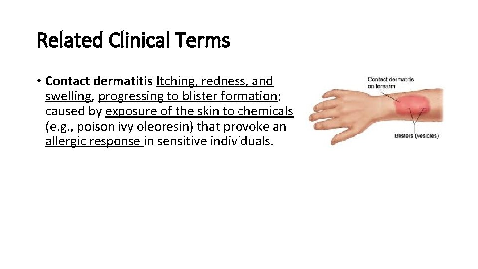 Related Clinical Terms • Contact dermatitis Itching, redness, and swelling, progressing to blister formation;