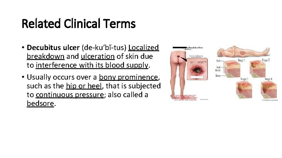 Related Clinical Terms • Decubitus ulcer (de-ku′bĭ-tus) Localized breakdown and ulceration of skin due