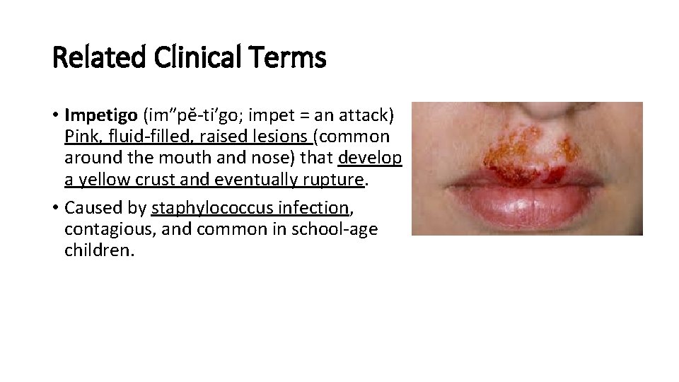 Related Clinical Terms • Impetigo (im″pĕ-ti′go; impet = an attack) Pink, fluid-filled, raised lesions