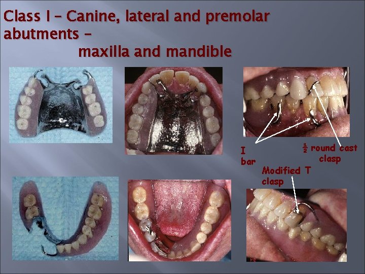 Class I – Canine, lateral and premolar abutments – maxilla and mandible I bar