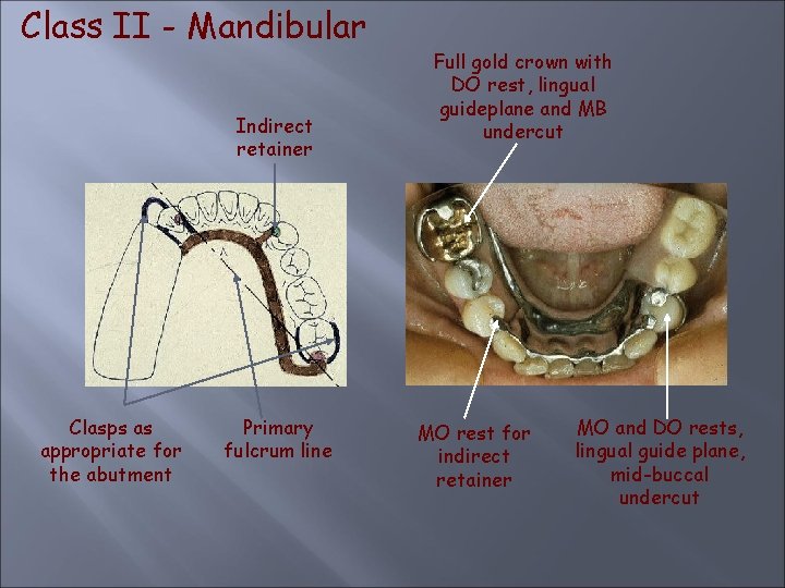 Class II - Mandibular Indirect retainer Clasps as appropriate for the abutment Primary fulcrum