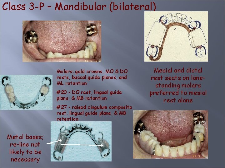 Class 3 -P – Mandibular (bilateral) Molars: gold crowns, MO & DO rests, buccal