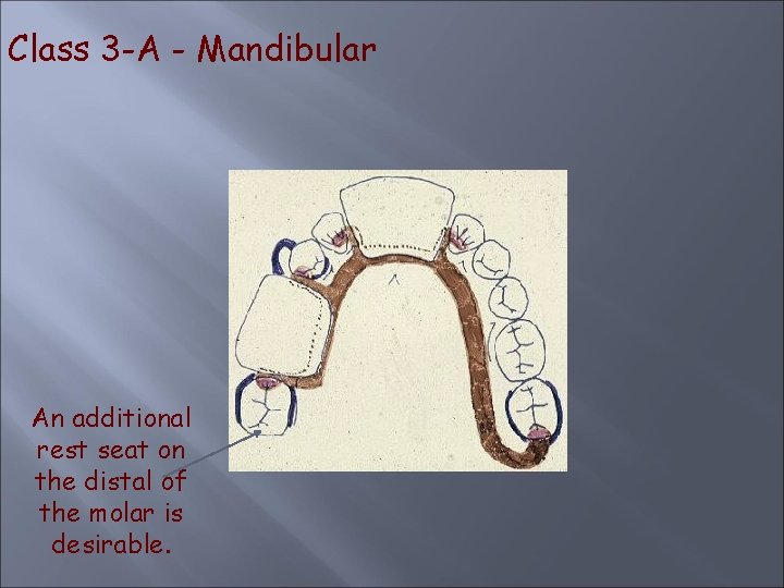 Class 3 -A - Mandibular An additional rest seat on the distal of the
