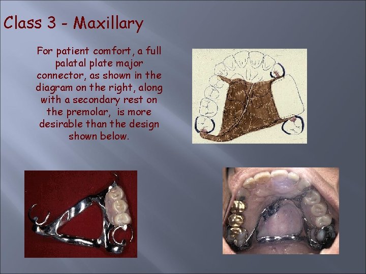 Class 3 - Maxillary For patient comfort, a full palatal plate major connector, as