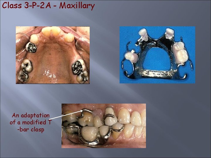 Class 3 -P-2 A - Maxillary An adaptation of a modified T -bar clasp