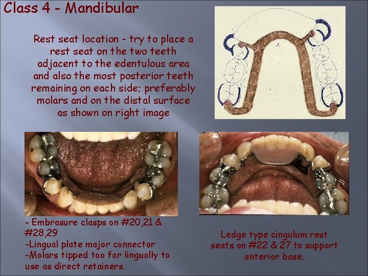 Class 4 - Mandibular Rest seat location - try to place a rest seat