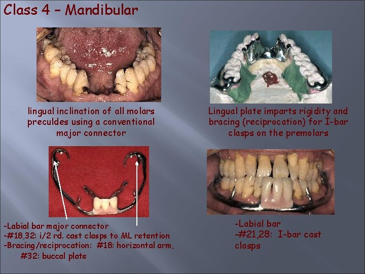 Class 4 – Mandibular lingual inclination of all molars preculdes using a conventional major