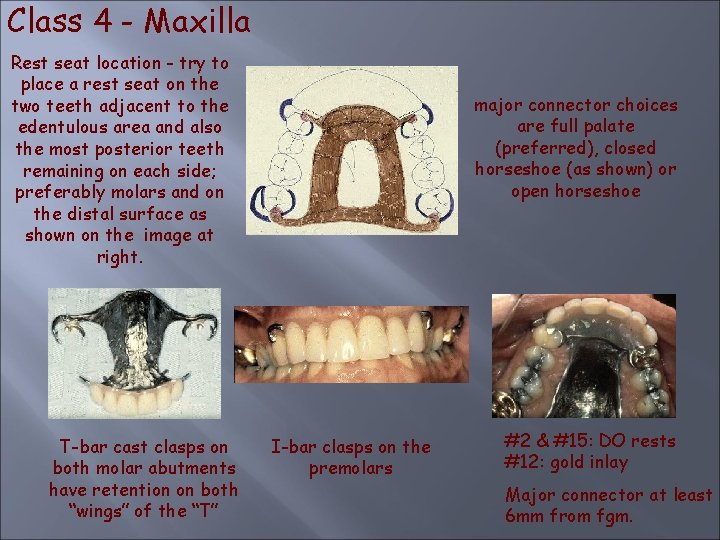 Class 4 - Maxilla Rest seat location - try to place a rest seat