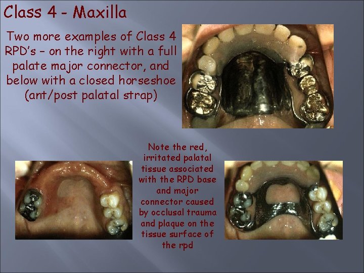 Class 4 - Maxilla Two more examples of Class 4 RPD’s – on the