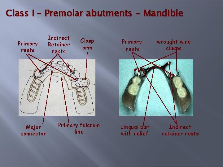 Class I – Premolar abutments - Mandible Primary rests Major connector Indirect Retainer rests