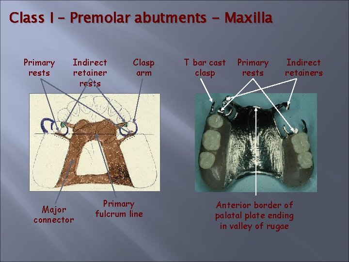 Class I – Premolar abutments - Maxilla Primary rests Indirect retainer rests Major connector