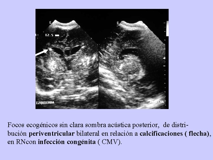 Focos ecogénicos sin clara sombra acústica posterior, de distribución periventricular bilateral en relación a