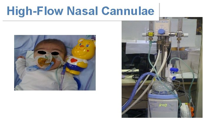 High-Flow Nasal Cannulae 