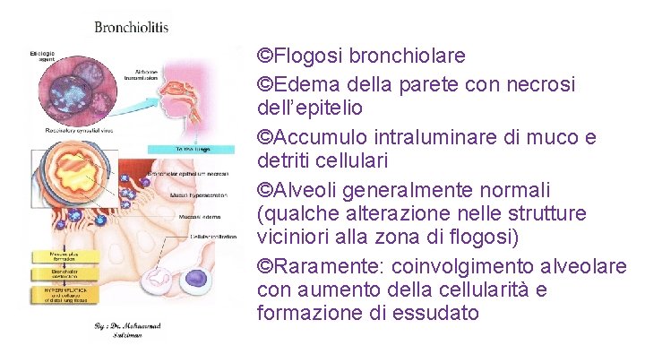 ©Flogosi bronchiolare ©Edema della parete con necrosi dell’epitelio ©Accumulo intraluminare di muco e detriti