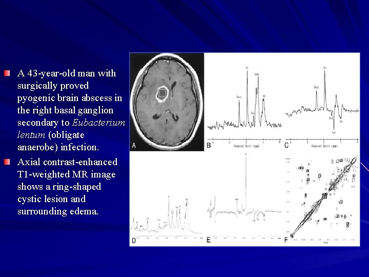 A 43 -year-old man with surgically proved pyogenic brain abscess in the right basal