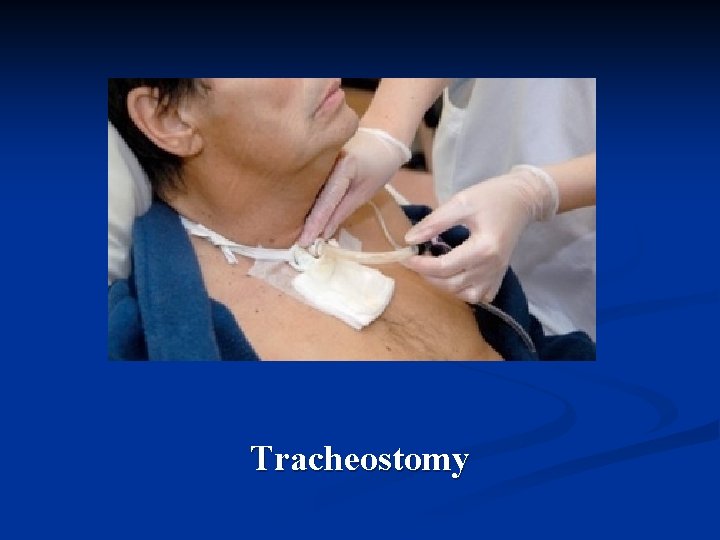 Tracheostomy 