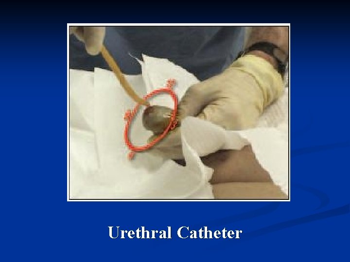 Urethral Catheter 