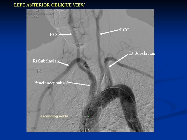 LEFT ANTERIOR OBLIQUE VIEW RCC Lt Subclavian Rt Subclavian Brachiocephalic A 