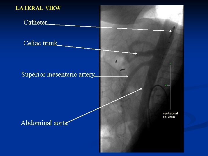 LATERAL VIEW Catheter Celiac trunk Superior mesenteric artery Abdominal aorta 