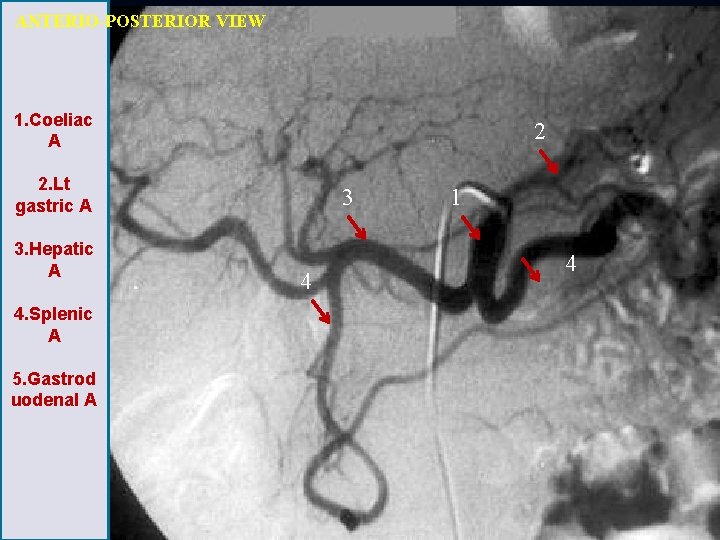 ANTERIO-POSTERIOR VIEW 1. Coeliac A 2 2. Lt gastric A 3. Hepatic A 4.