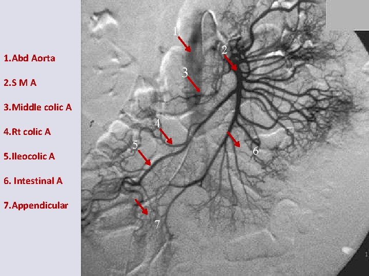 1 2 1. Abd Aorta 3 2. S M A 3. Middle colic A