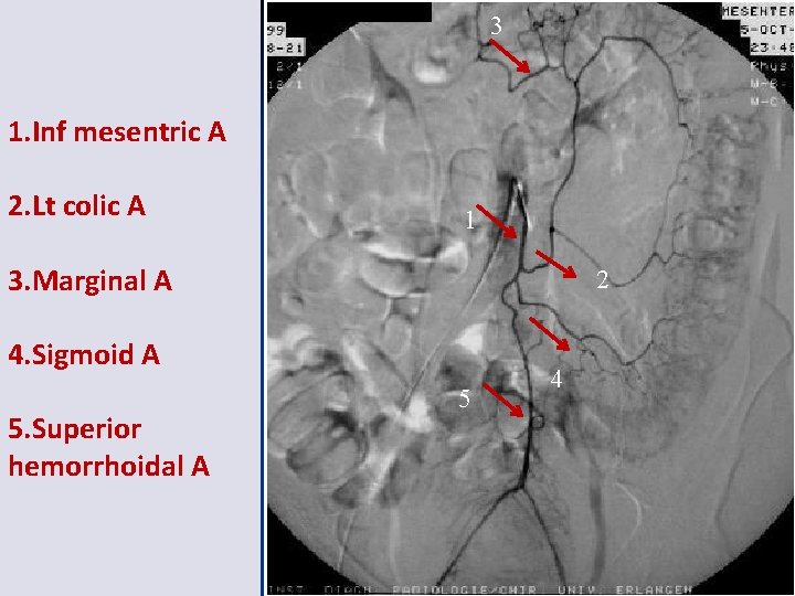3 1. Inf mesentric A 2. Lt colic A 1 3. Marginal A 2