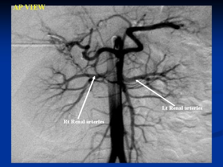 AP VIEW Lt Renal arteries Rt Renal arteries 