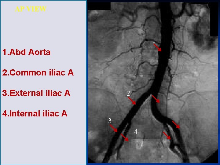 AP VIEW 1 1. Abd Aorta 2. Common iliac A 3. External iliac A