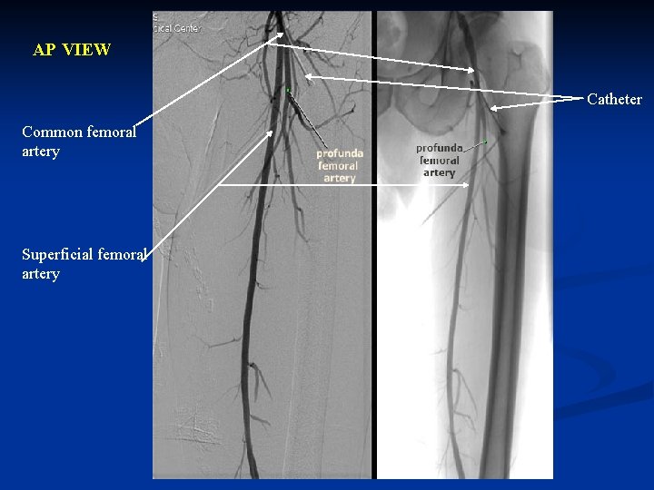 AP VIEW Catheter Common femoral artery Superficial femoral artery 