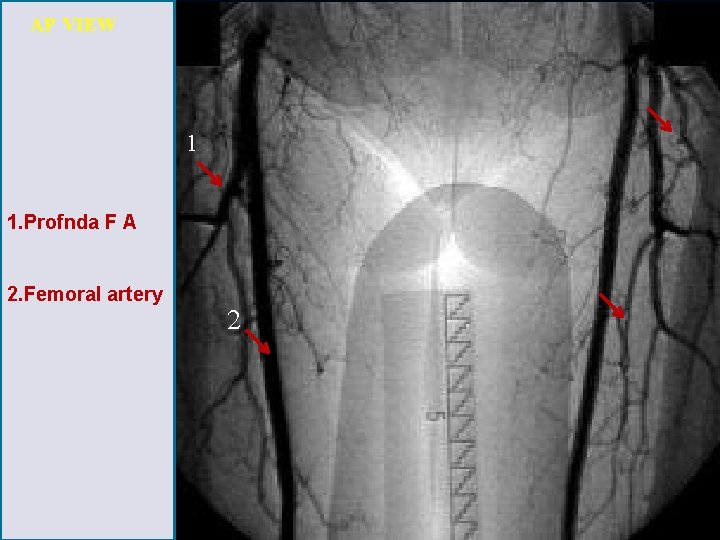 AP VIEW 1 1. Profnda F A 2. Femoral artery 2 
