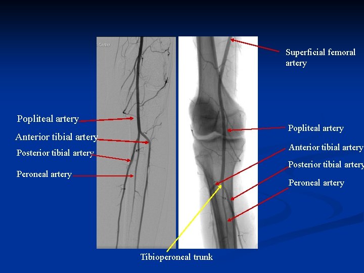 Superficial femoral artery Popliteal artery Anterior tibial artery Posterior tibial artery Peroneal artery Tibioperoneal