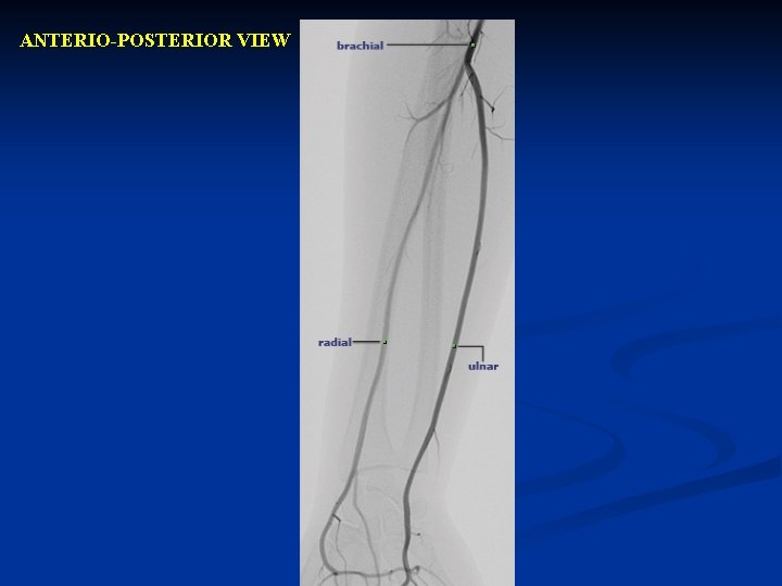 ANTERIO-POSTERIOR VIEW 