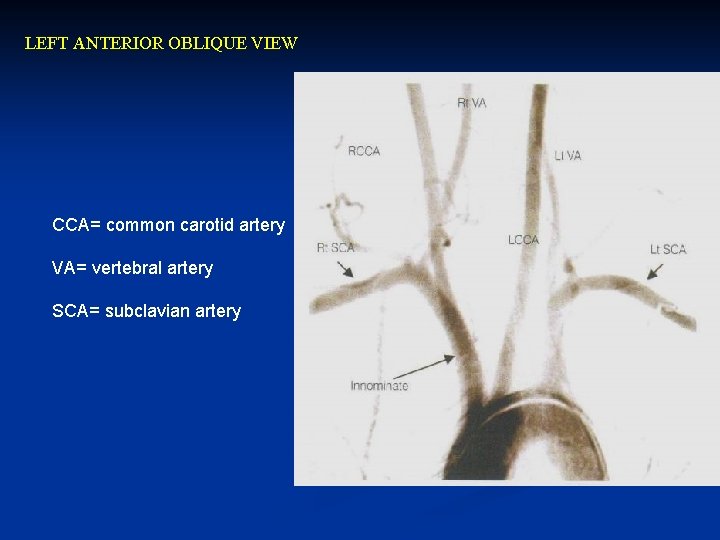 LEFT ANTERIOR OBLIQUE VIEW CCA= common carotid artery VA= vertebral artery SCA= subclavian artery