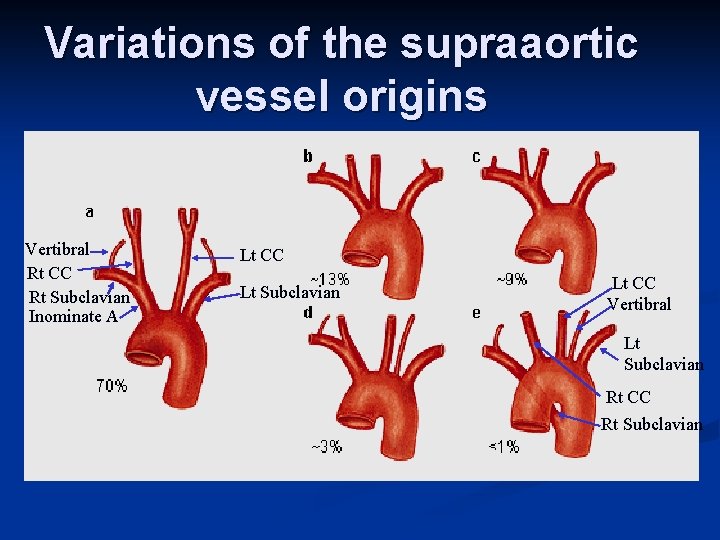 Variations of the supraaortic vessel origins Vertibral Rt CC Rt Subclavian Inominate A Lt